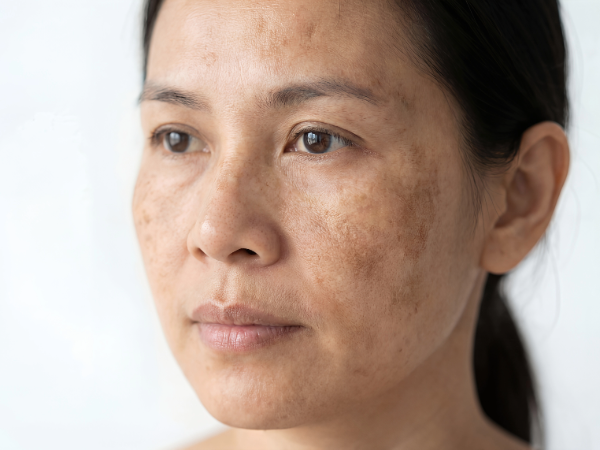 Dark Spots